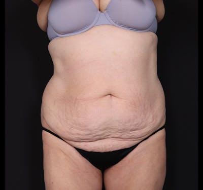 New Jersey Liposuction Before & After Gallery - Patient 385591 - Image 1