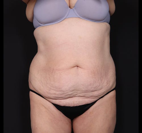 New Jersey Tummy Tuck Before & After Gallery - Patient Mbb_vEXFQSygC_XvG62Dvg - Image 1