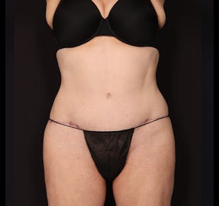 New Jersey Tummy Tuck Before & After Gallery - Patient 198833 - Image 2