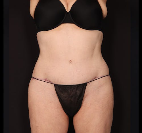 New Jersey Tummy Tuck Before & After Gallery - Patient Mbb_vEXFQSygC_XvG62Dvg - Image 2