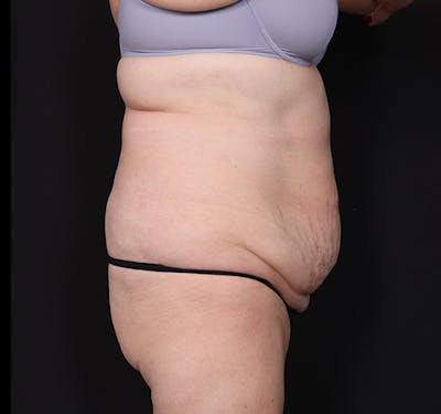 New Jersey Liposuction Before & After Gallery - Patient 385591 - Image 5