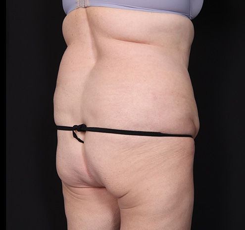 New Jersey Tummy Tuck Before & After Gallery - Patient 198833 - Image 7