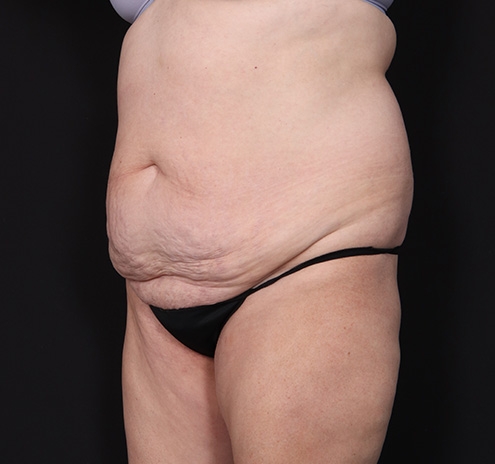 New Jersey Tummy Tuck Before & After Gallery - Patient 198833 - Image 9