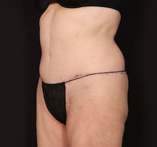 New Jersey Tummy Tuck Before & After Gallery - Patient 198833 - Image 10