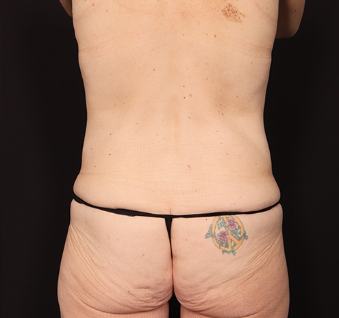 New Jersey Post Weight Loss Body Contouring Before & After Gallery - Patient 200763 - Image 9