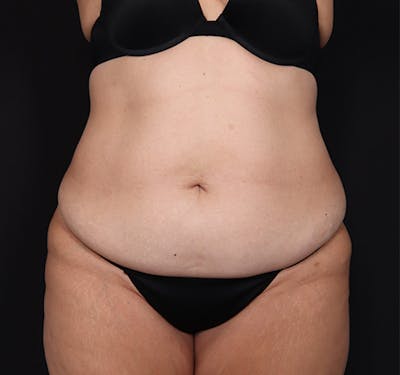 New Jersey Tummy Tuck Before & After Gallery - Patient 404710 - Image 1