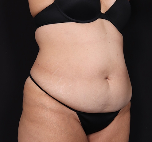 New Jersey Tummy Tuck Before & After Gallery - Patient 404710 - Image 3
