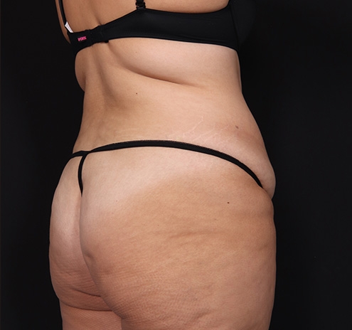 New Jersey Tummy Tuck Before & After Gallery - Patient 404710 - Image 7