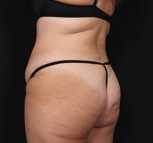 New Jersey Tummy Tuck Before & After Gallery - Patient 404710 - Image 11