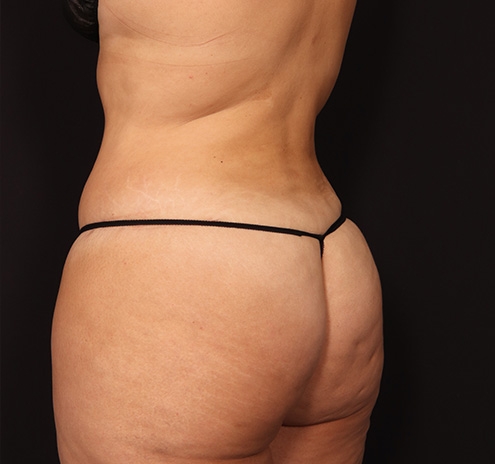 New Jersey Tummy Tuck Before & After Gallery - Patient 404710 - Image 12