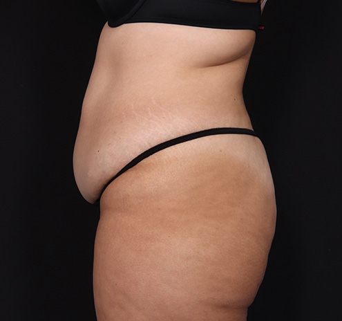 New Jersey Tummy Tuck Before & After Gallery - Patient 404710 - Image 13