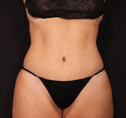 New Jersey Tummy Tuck Before & After Gallery - Patient 404710 - Image 2