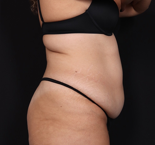 New Jersey Tummy Tuck Before & After Gallery - Patient 404710 - Image 5