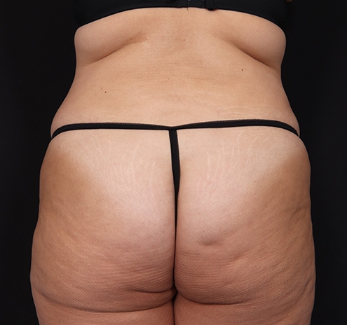 New Jersey Tummy Tuck Before & After Gallery - Patient 404710 - Image 9