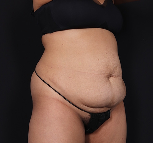 New Jersey Tummy Tuck Before & After Gallery - Patient 328538 - Image 3