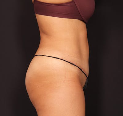 New Jersey Tummy Tuck Before & After Gallery - Patient 328538 - Image 6