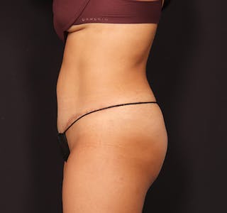 New Jersey Tummy Tuck Before & After Gallery - Patient 328538 - Image 14