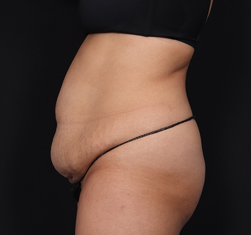 New Jersey Tummy Tuck Before & After Gallery - Patient 328538 - Image 13