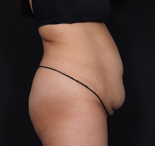 New Jersey Tummy Tuck Before & After Gallery - Patient 328538 - Image 5