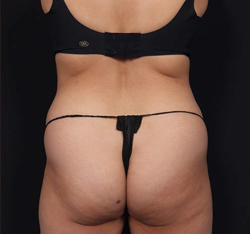New Jersey Tummy Tuck Before & After Gallery - Patient 328538 - Image 9