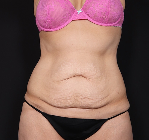 New Jersey Tummy Tuck Before & After Gallery - Patient 189079 - Image 1