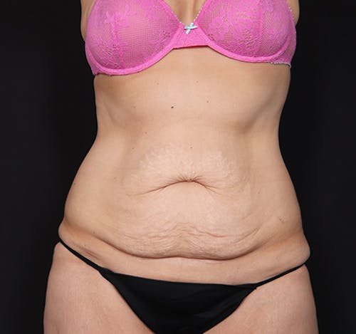 New Jersey Tummy Tuck Before & After Gallery - Patient VtgYELSwQoquAm9WbSr8tw - Image 1
