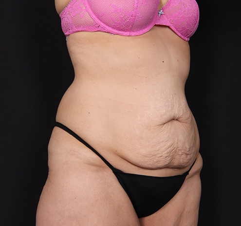 New Jersey Tummy Tuck Before & After Gallery - Patient 189079 - Image 3