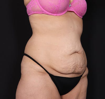 New Jersey Tummy Tuck Before & After Gallery - Patient 189079 - Image 3
