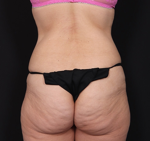 New Jersey Tummy Tuck Before & After Gallery - Patient 189079 - Image 8