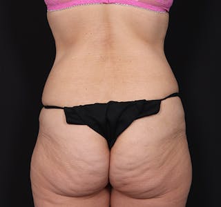 New Jersey Tummy Tuck Before & After Gallery - Patient 189079 - Image 8