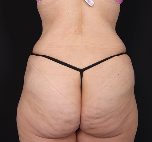 New Jersey Tummy Tuck Before & After Gallery - Patient 189079 - Image 7