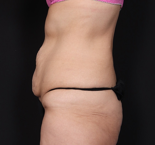 New Jersey Tummy Tuck Before & After Gallery - Patient 189079 - Image 9