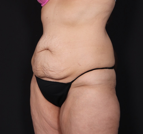 New Jersey Tummy Tuck Before & After Gallery - Patient 189079 - Image 11