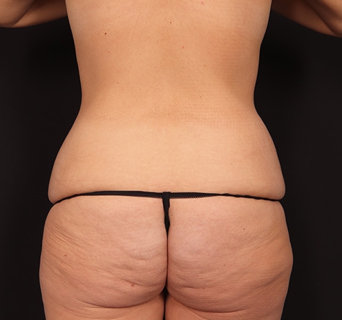 New Jersey Mommy Makeover Before & After Gallery - Patient 333844 - Image 9