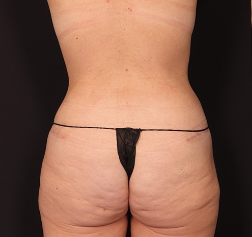 New Jersey Mommy Makeover Before & After Gallery - Patient 333844 - Image 10
