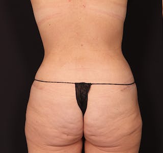 New Jersey Mommy Makeover Before & After Gallery - Patient 333844 - Image 10
