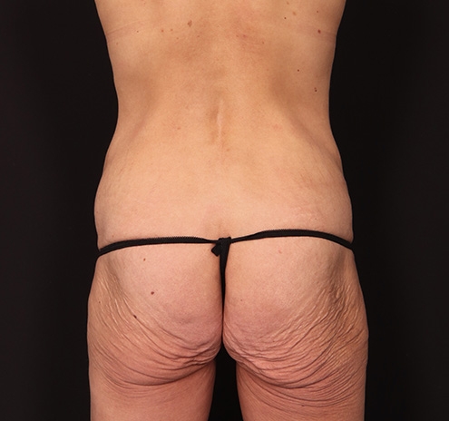 New Jersey Mommy Makeover Before & After Gallery - Patient 738066 - Image 9