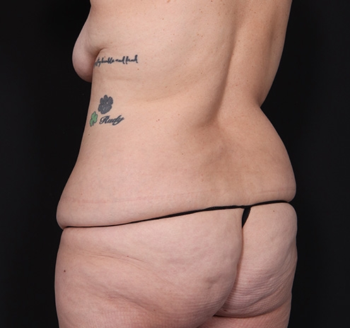 New Jersey Mommy Makeover Before & After Gallery - Patient 361205 - Image 11