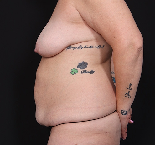 New Jersey Mommy Makeover Before & After Gallery - Patient 361205 - Image 13