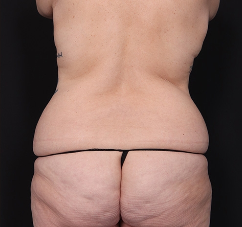 New Jersey Mommy Makeover Before & After Gallery - Patient 361205 - Image 9