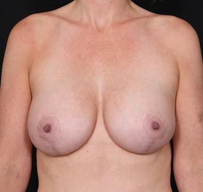 New Jersey Breast Lift Before & After Gallery - Patient 325068 - Image 2