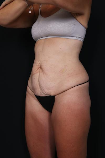 New Jersey Post Weight Loss Body Contouring Before & After Gallery - Patient 191373 - Image 1