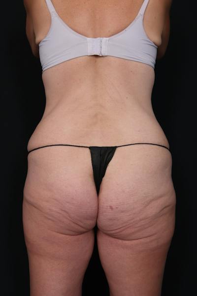 New Jersey Liposuction Before & After Gallery - Patient 135230 - Image 1