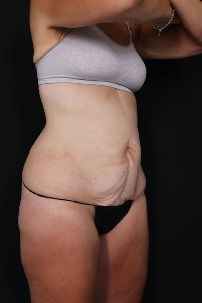 New Jersey Liposuction Before & After Gallery - Patient 135230 - Image 3