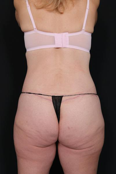 New Jersey Liposuction Before & After Gallery - Patient 135230 - Image 2