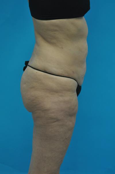 New Jersey Post Weight Loss Body Contouring Before & After Gallery - Patient 712281 - Image 5