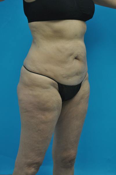 New Jersey Post Weight Loss Body Contouring Before & After Gallery - Patient 712281 - Image 3