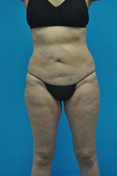 New Jersey Post Weight Loss Body Contouring Before & After Gallery - Patient 712281 - Image 1