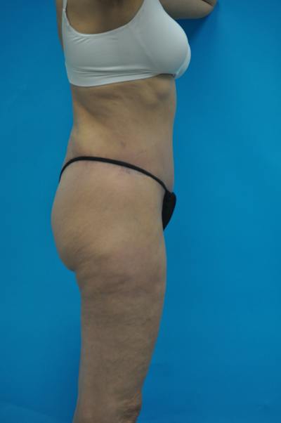New Jersey Post Weight Loss Body Contouring Before & After Gallery - Patient 712281 - Image 6