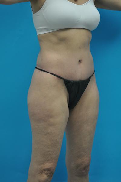 New Jersey Post Weight Loss Body Contouring Before & After Gallery - Patient 712281 - Image 4